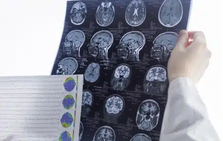 CURE Epilepsy Grantee Makes Strides in the Understanding of Acquired Epilepsies by Investigating Inflammation in the Brain