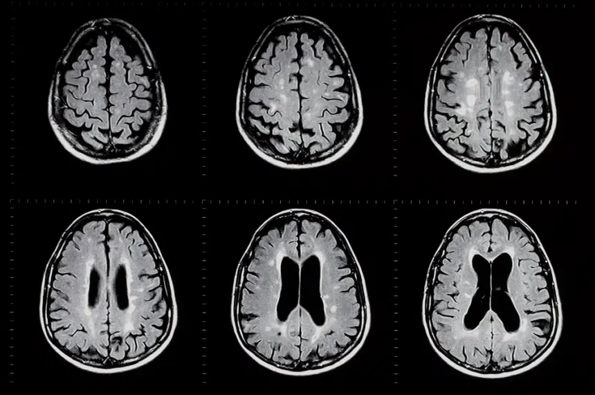 Series of six MRI brain scans in two rows and three columns.