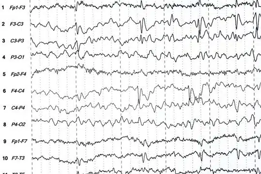 EEG document showing brain activity of a person.