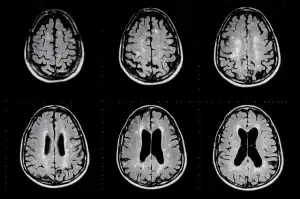 MRI brain scans showing six cross-sectional images in two rows.
