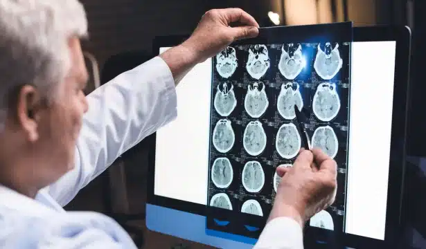 Researcher holding up brain scan to light