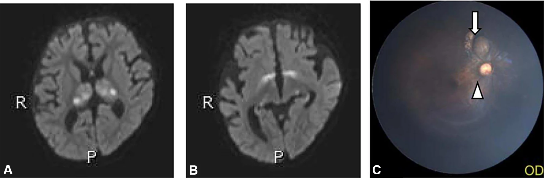The female patient with West syndrome, was started on VGB at a dose of 75.0 mg/kg per day at the age of six months, with a cumulative VGB dose of approximately 141.5 g. A. DWI sequence showed bilateral thalamic symmetrical hyper-intensity, heterogeneous. B. DWI sequences showed abnormal hyper-intensity in the bilateral symmetric globus pallidum, medial geniculate body, and lateral geniculate body with slightly less uniform signal. C. Long arrows refer to retinopathy, and triangles refer to the optic disc.