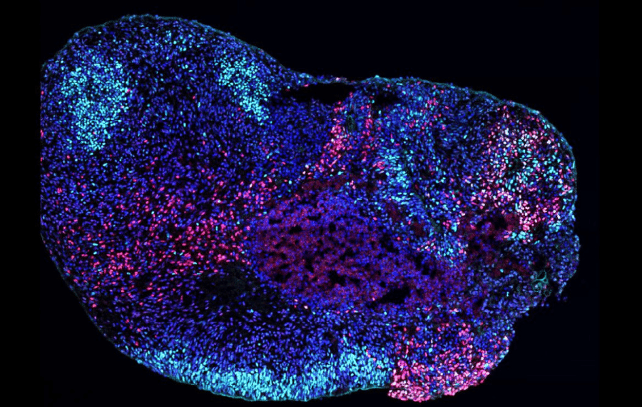 Microscopy image of a human stem cell-derived hippocampal organoid. When the tissue carries an epilepsy-causing variant in the SCN8A gene, inhibitory neurons (seen in red) are disrupted, and hippocampal brainwave activity patterns are altered.